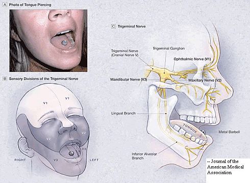 Tongue Piercing Side Effects